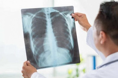 О лечении бронхитов